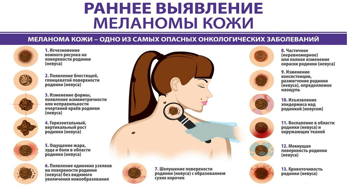 Нужно ли удалять родинки?