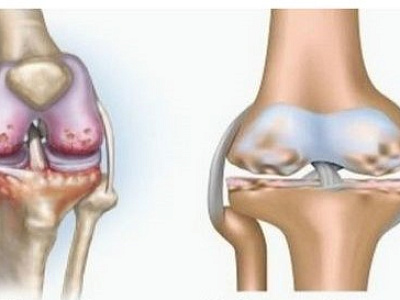 Остеоартроз – самое частое заболевание суставов (в рамках Всемирного дня артрита)